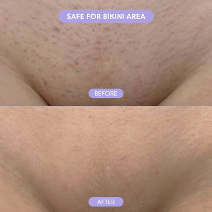 SilkSmooth™ — Body Hair Removal Spray