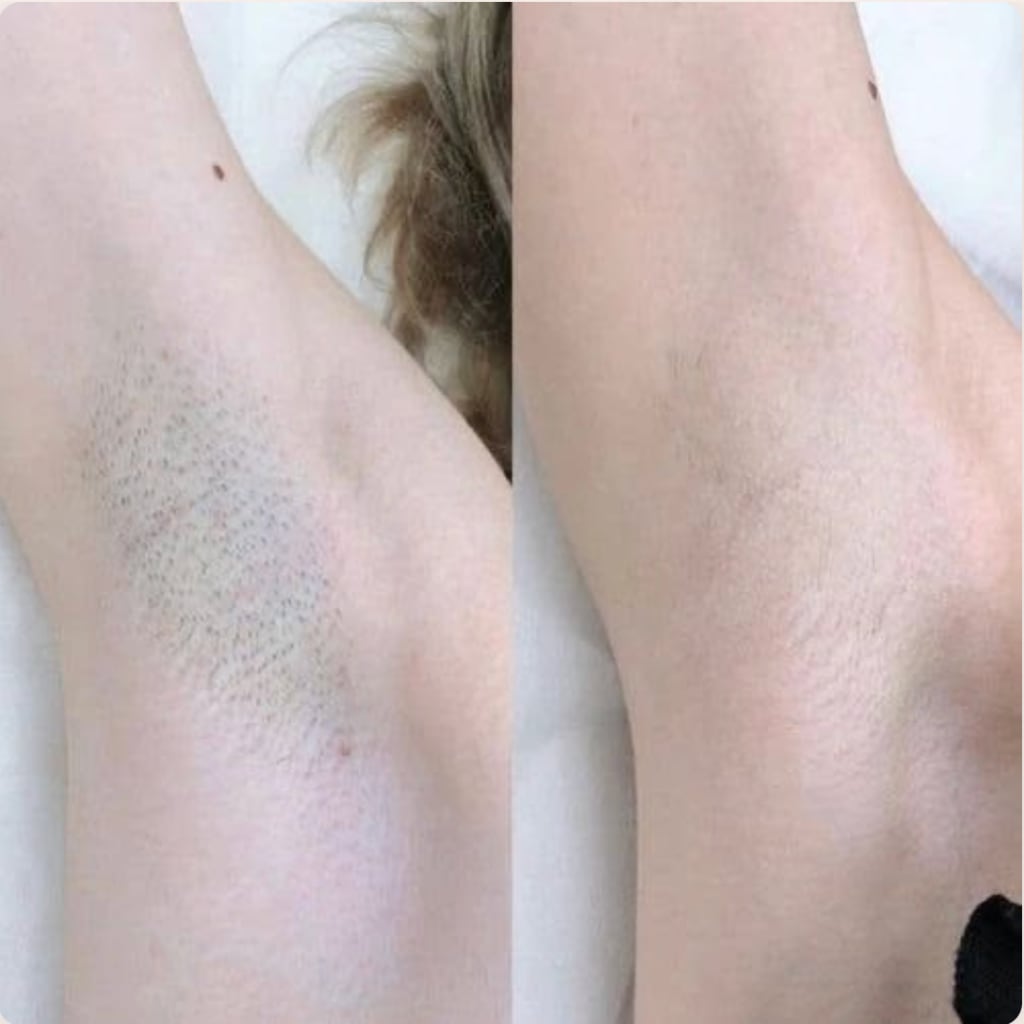 SilkSmooth™ — Body Hair Removal Spray